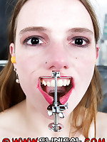 Mouth spreader picture #4
